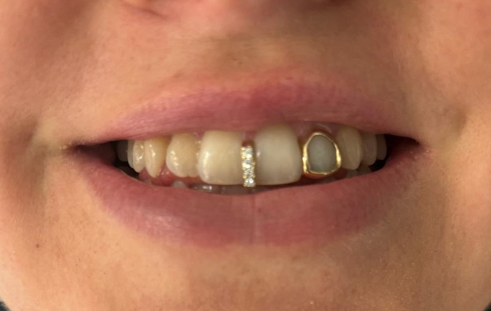Moissanite Gap filler